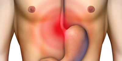 Soigner Naturellement vos Brûlures D’estomac