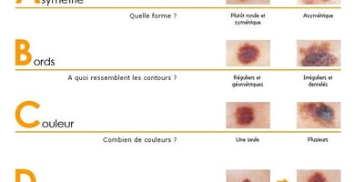 Surveiller ses Grains de Beauté