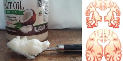 Un Homme Mange 2 Cuillères à Soupe D’huile de Coco 2 Fois par Jour Pendant 60 Jours et Voici ce qui Arrive à son Cerveau !