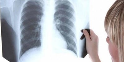 Un Médecin Affirme que Cette Vitamine Traite la Pneumonie en 3 Heures