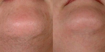 Une Vieille Recette Russe pour une Épilation Permanente au Naturel Une Vieille Recette Russe pour une Épilation Permanente au Naturel