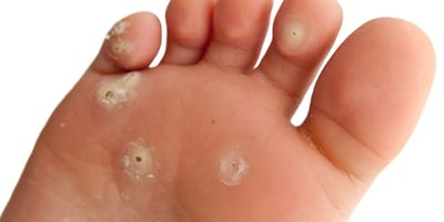 VERRUE PLANTAIRE : ASTUCE DE GRAND MÈRE