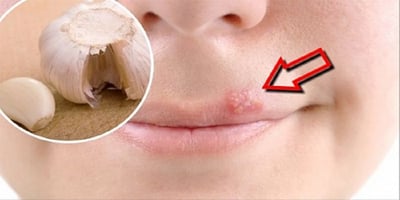 Voici une Astuce Simple pour Soigner L'herpès Voici une Astuce Simple pour Soigner L'herpès