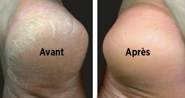 Astuce Naturelle pour Traiter les Pieds Secs et Fendillés