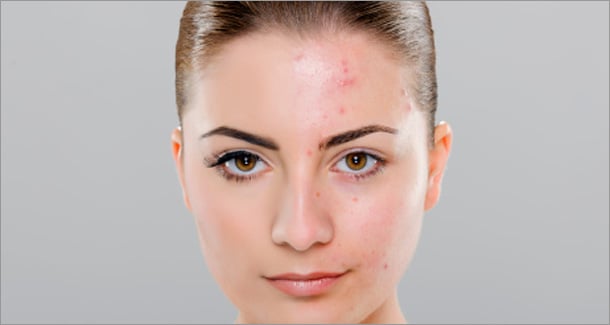 L'acné, Comment Régler le Problème?